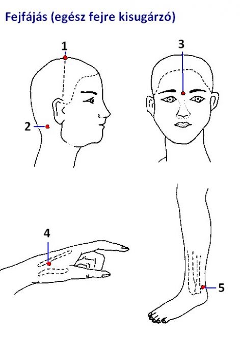 fejfájás (egész_fejre kisugárzó) akupunktúrás pontok
