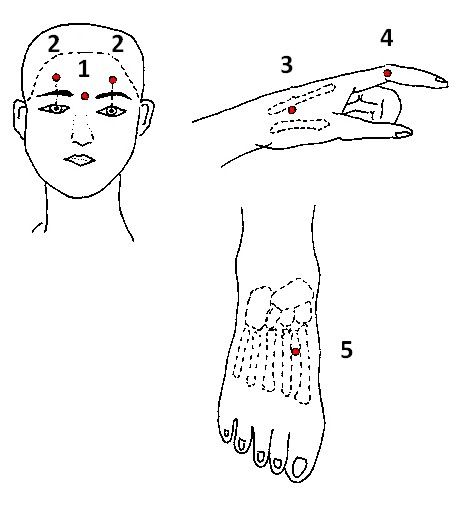 fejfájás (homloktájon) akupunktúrás pontok